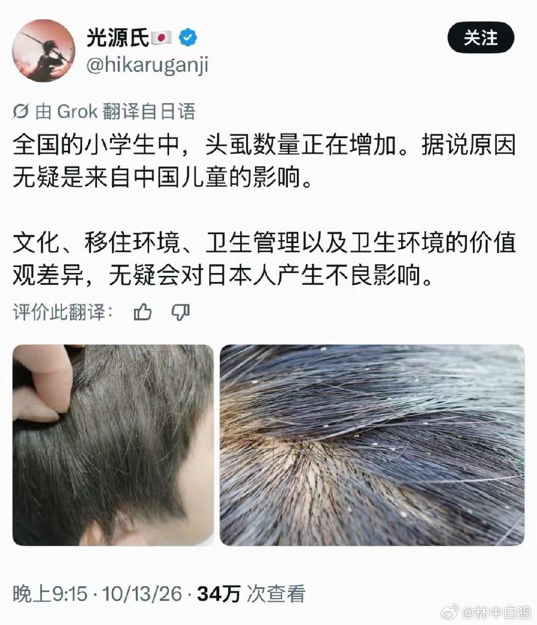 日本网民：“日本小学生长头虱的变多了，这无疑是来自中国儿童的影响。”长头虱说明不
