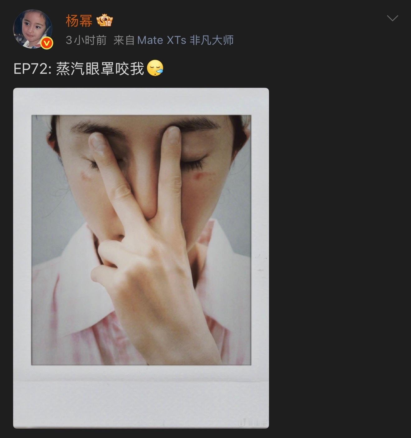张馨予也被蒸汽眼罩烫伤过用这些东西的时候，还是注意一点吧 