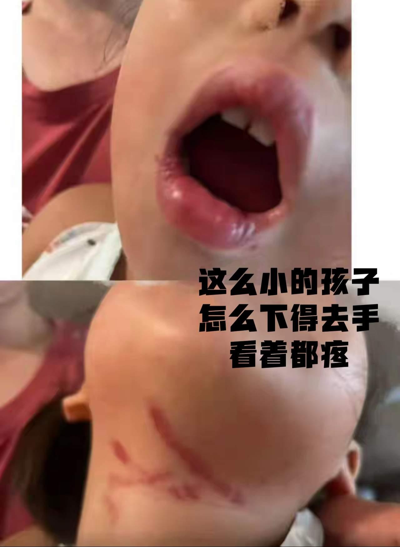3岁半的孩子，只因吃饭慢了点，竟被男老师用不锈钢勺死死顶住下颌，硬生生撬开嘴灌饭