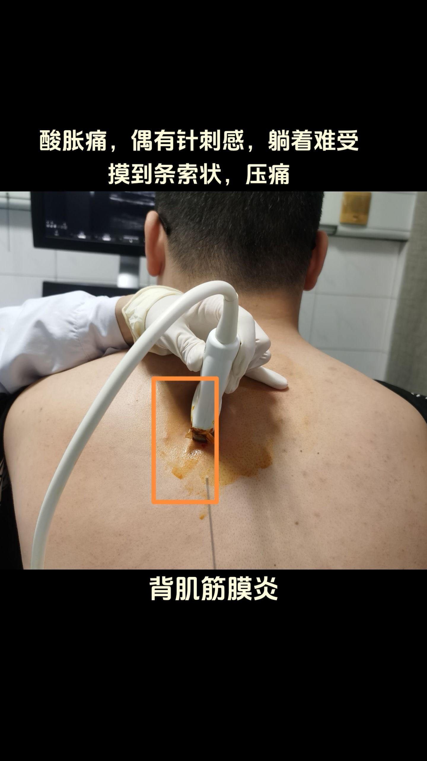 如图所示，摸到条索状硬块肌肉，压痛，难受，按摩可暂时缓解