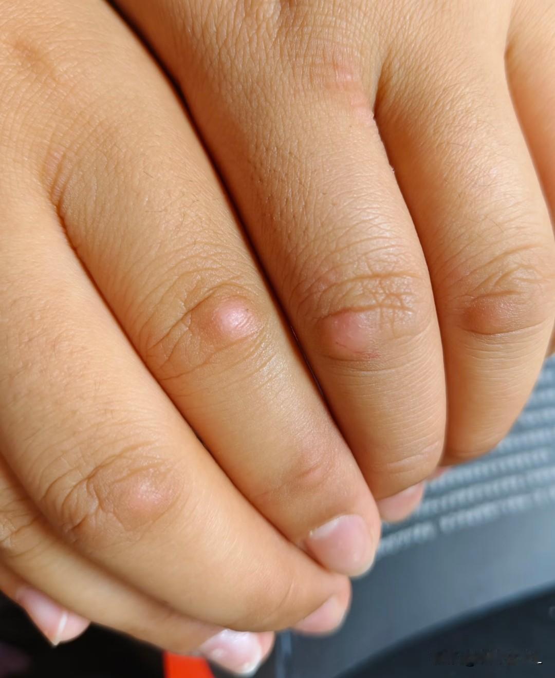 孩子手上这疙瘩是啥？硬硬的也不疼不痒