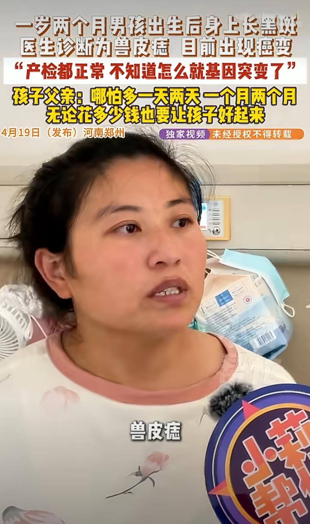 在河南郑州，有个一岁两个月的小男孩，出生后身上长了黑斑，医生诊断是兽皮痣，现在还