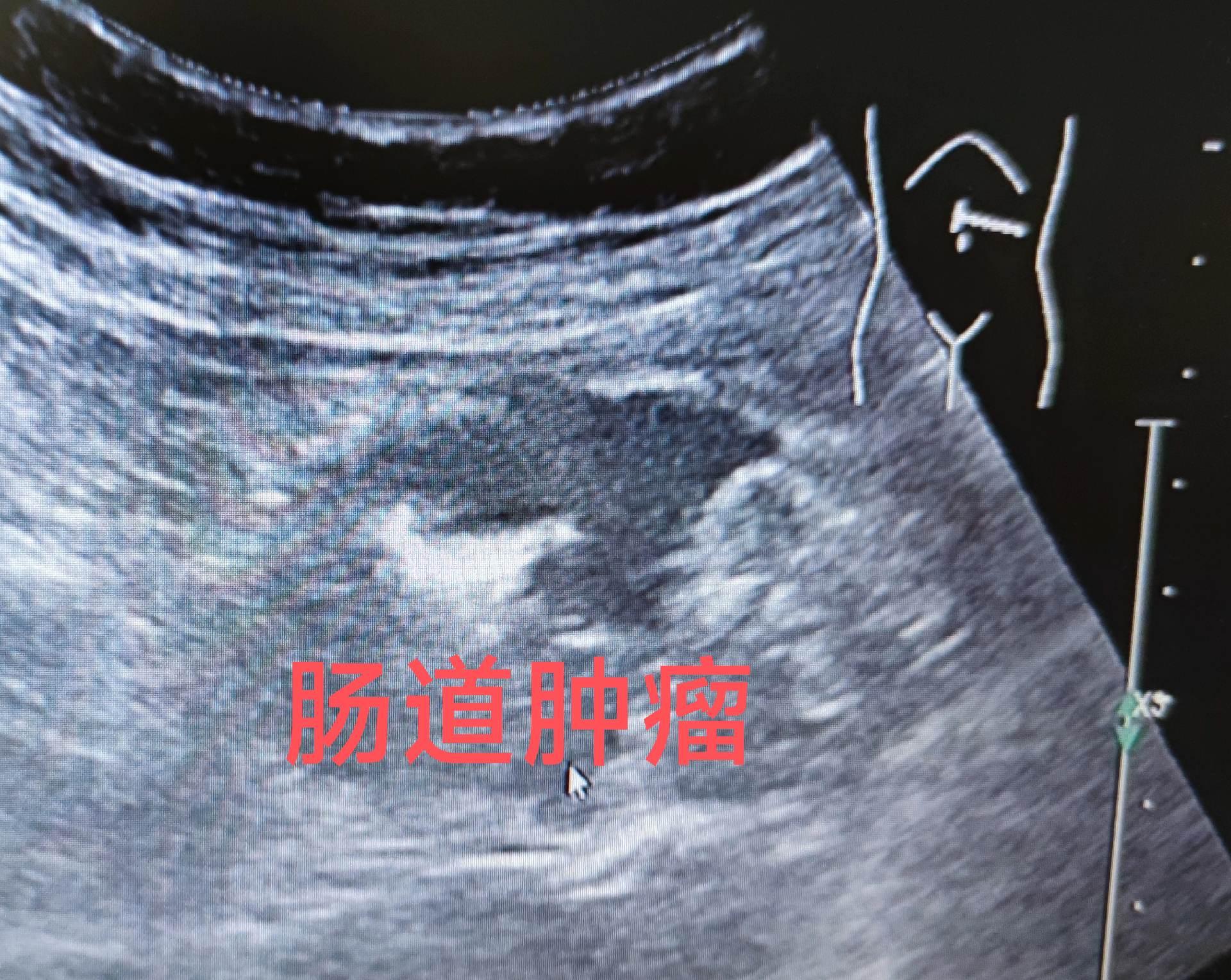 空肠肿瘤。老年女性 左中腹疼痛 肠壁低回声增厚，含气样包块 空肠肿瘤并...