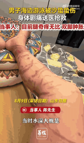 山东日照，男子下海游泳，谁能想到在浅水区突然遭遇了水下“隐形杀手”，当场像触了高