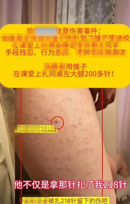 “如不严惩，天理难容！”山东济南，一女学生被转校生长期霸凌，身上有很多圆规、铁锥