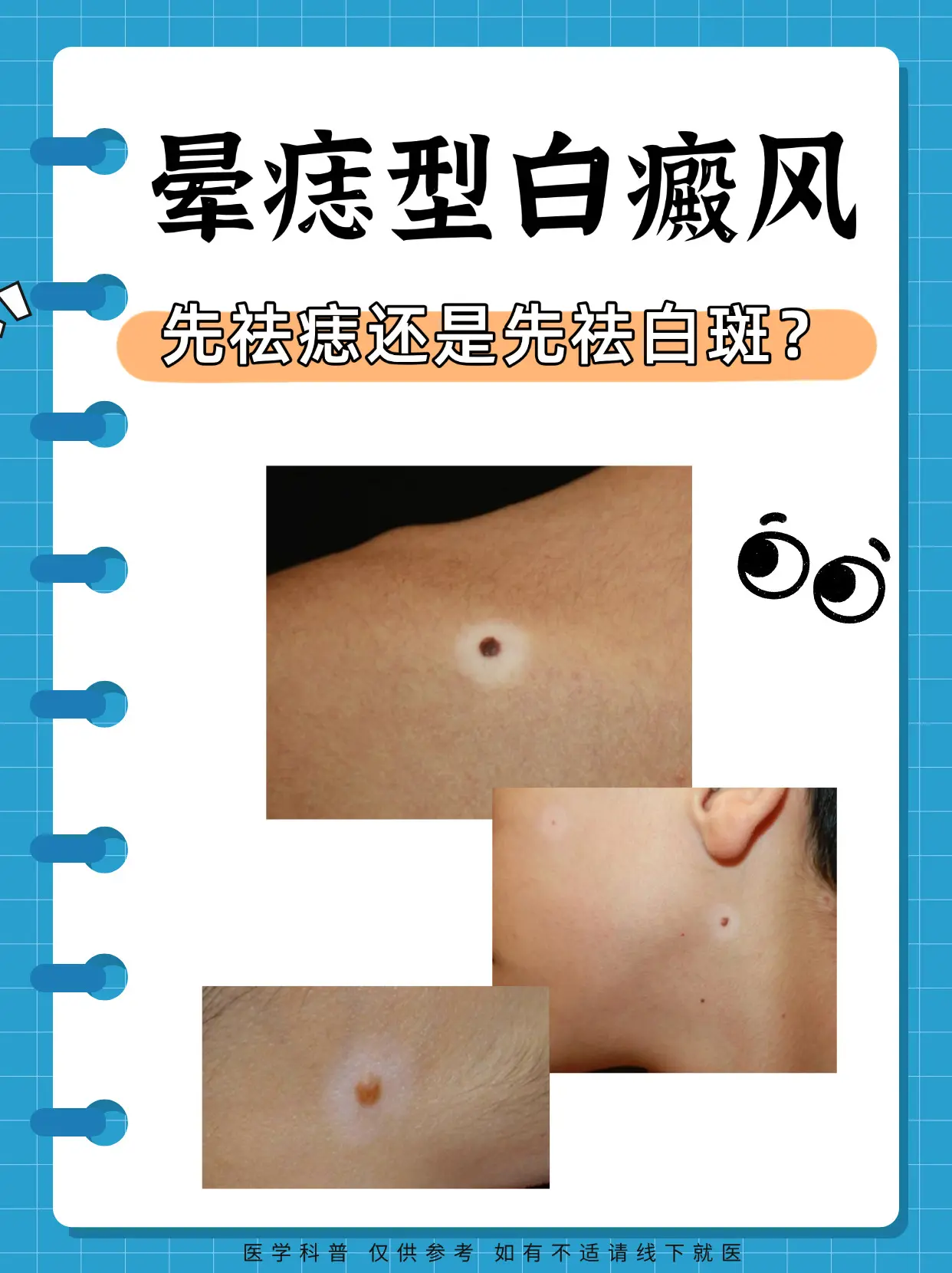 白癜风 白癜风科普 白斑 硬核健康科普行动  皮肤健康