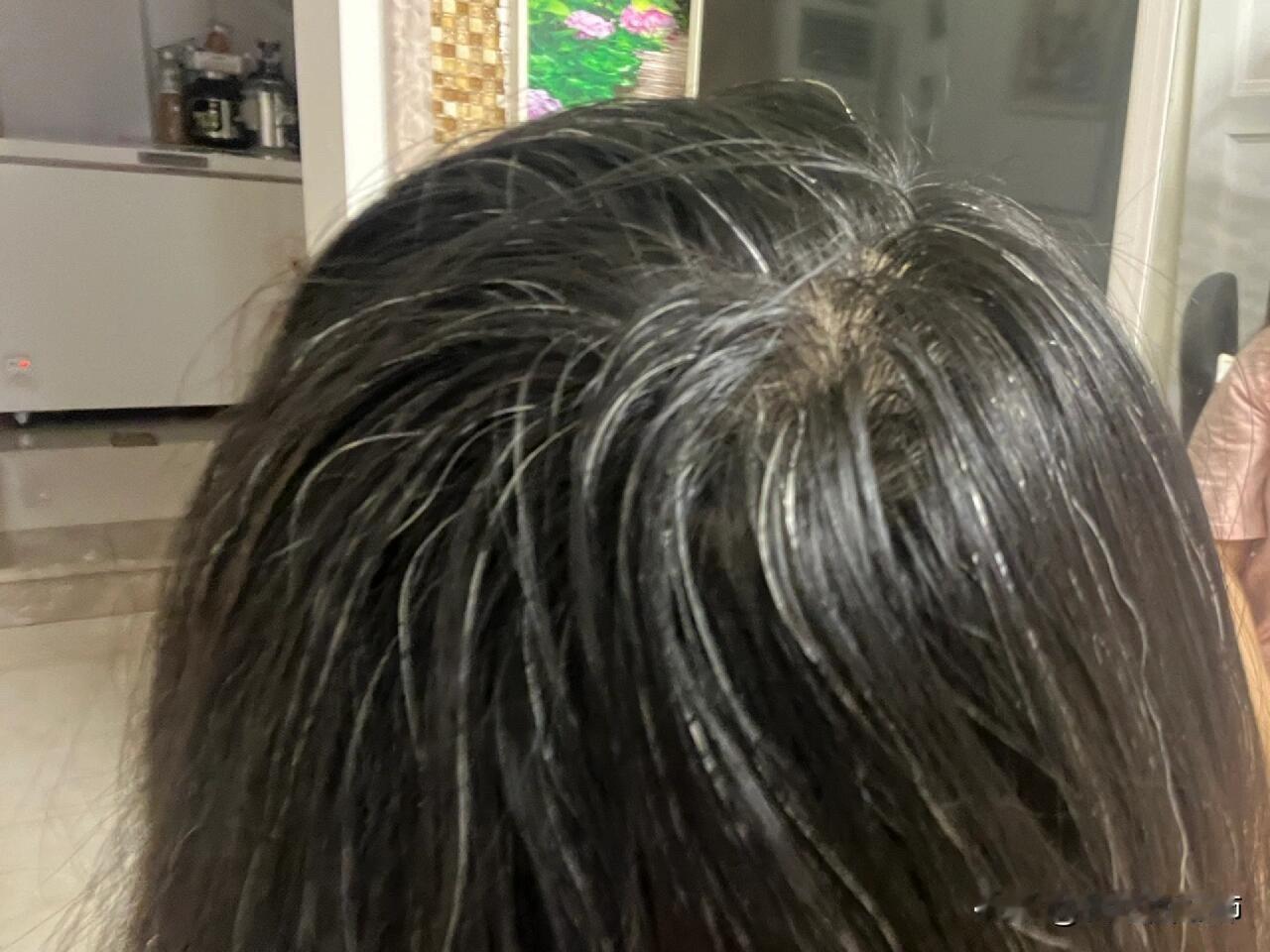 23岁少白头有办法治嘛
初中就长了
高中开始变多
一点点遗传 我爸也有 但是也不