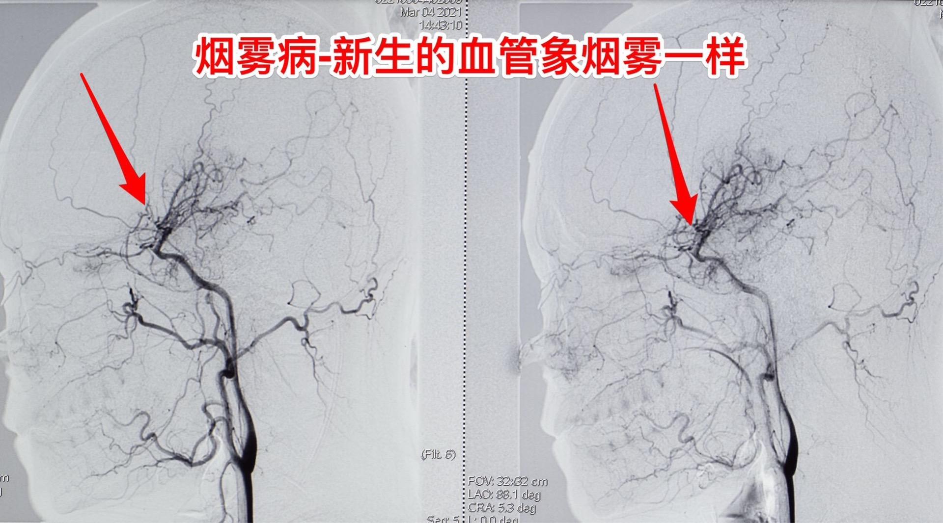 烟雾病-很常见也很险恶的病。烟雾病这个名字听起来像谜语一样，其实这是一...