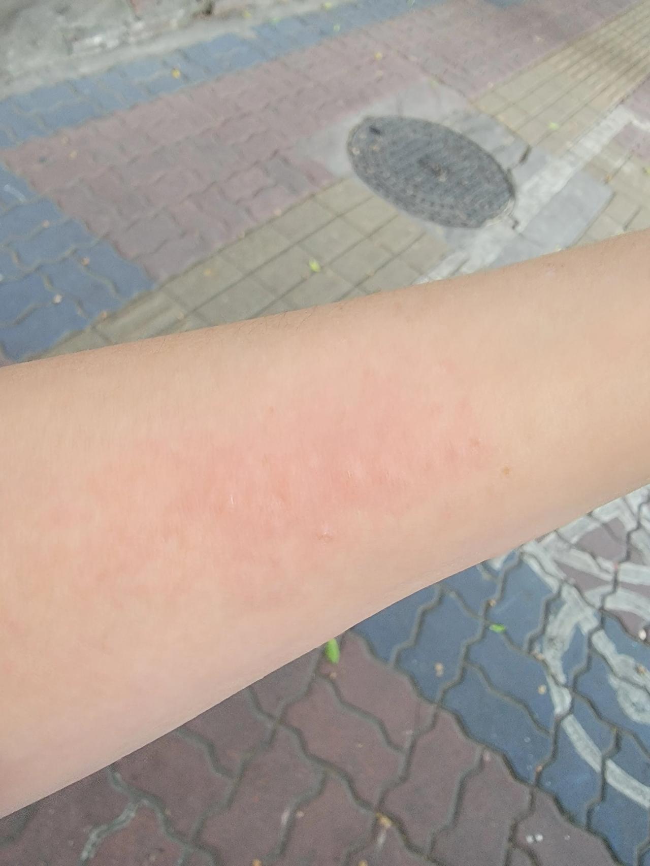 这两天暴晒，起痱子了，年年都要长一两次，不碰它会慢慢好，忍不住摸它就马上起小水泡