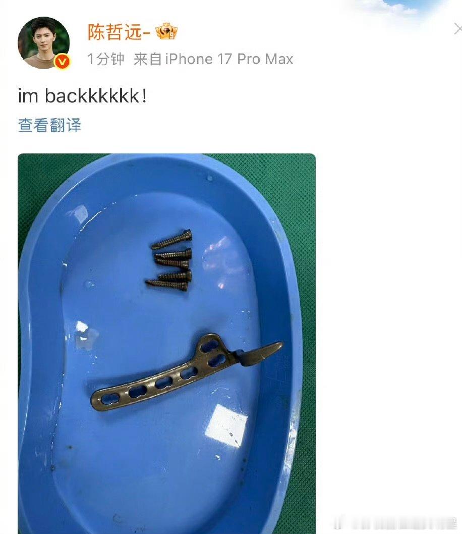 陈哲远晒取出的钢钉陈哲远晒取出的钢钉 