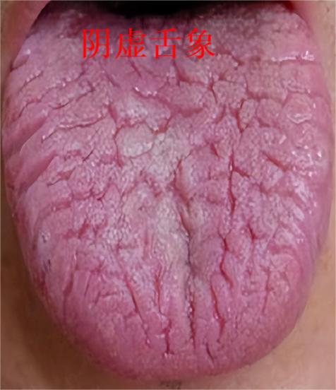 碰到这种裂纹舌，该怎么调理？今天教大家如何分辨，调理裂纹舌。
 
第一种，阴虚舌