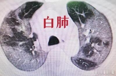 白肺，早期的症状有哪些？白肺，指，患者的肺部显影呈大片白色区域；一般是指重症肺炎