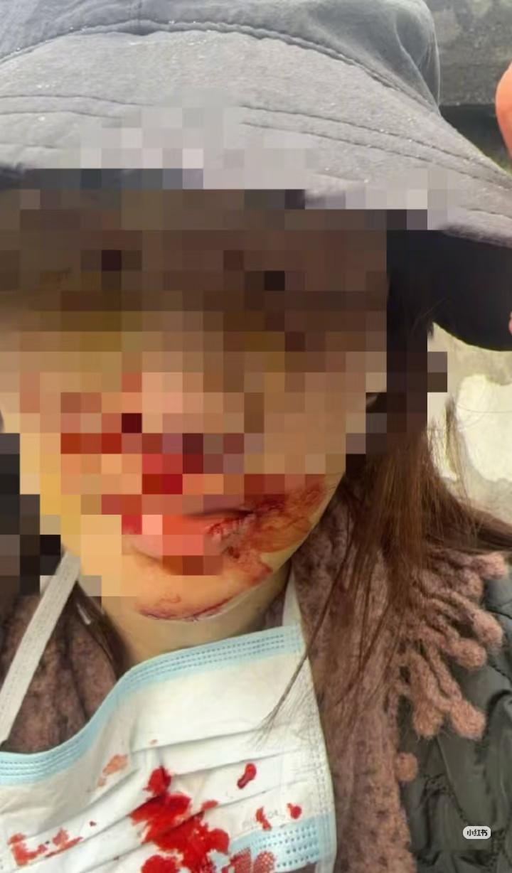 金晨道歉金晨公布车祸受伤照片金晨发文道歉，承认驾车发生交通事故后因受伤紧急就医，