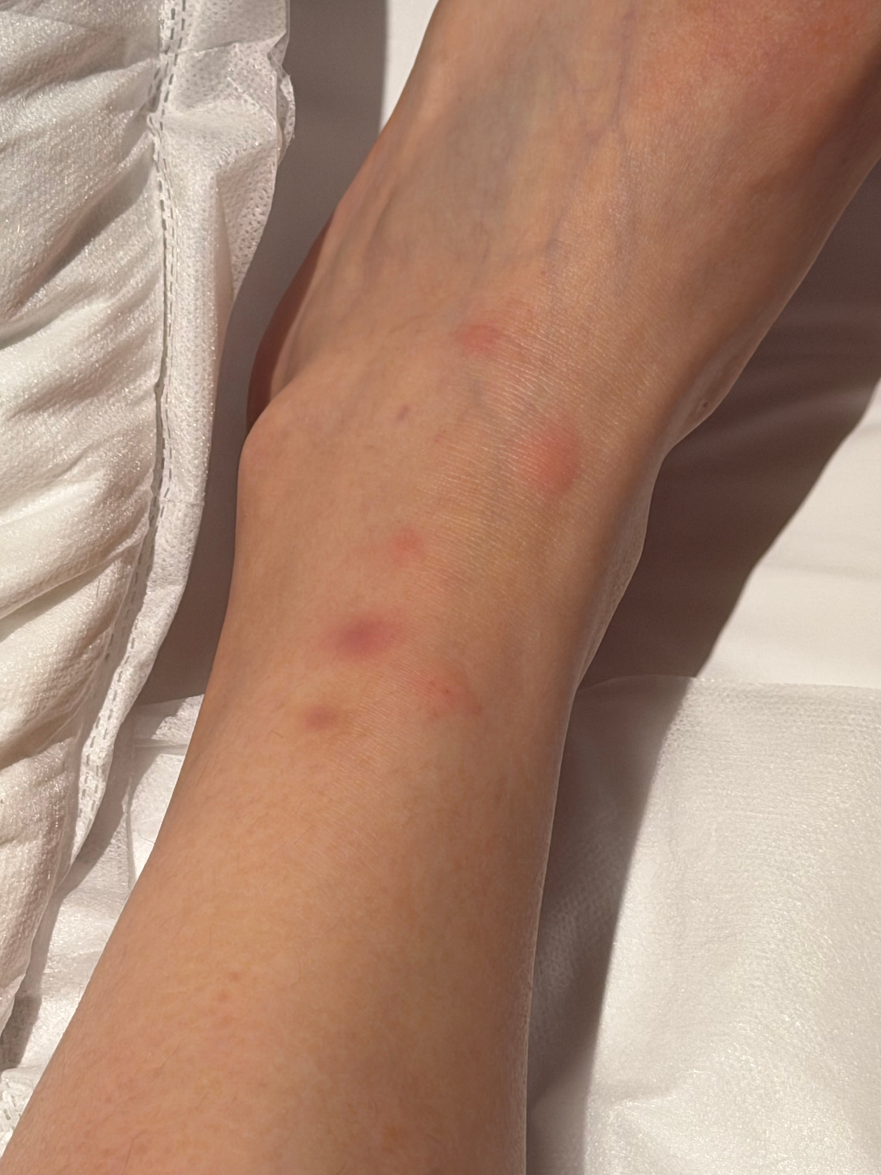 广西的蚊子你真是够了躲也躲不开 防也防不住 
