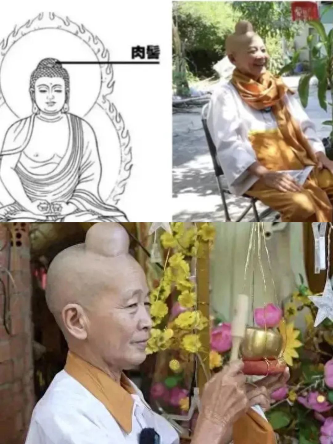 越南女子倪光头顶上长着和佛 祖一样的肉髻，父母带她去医院想要切掉肉髻，却被医生拒...