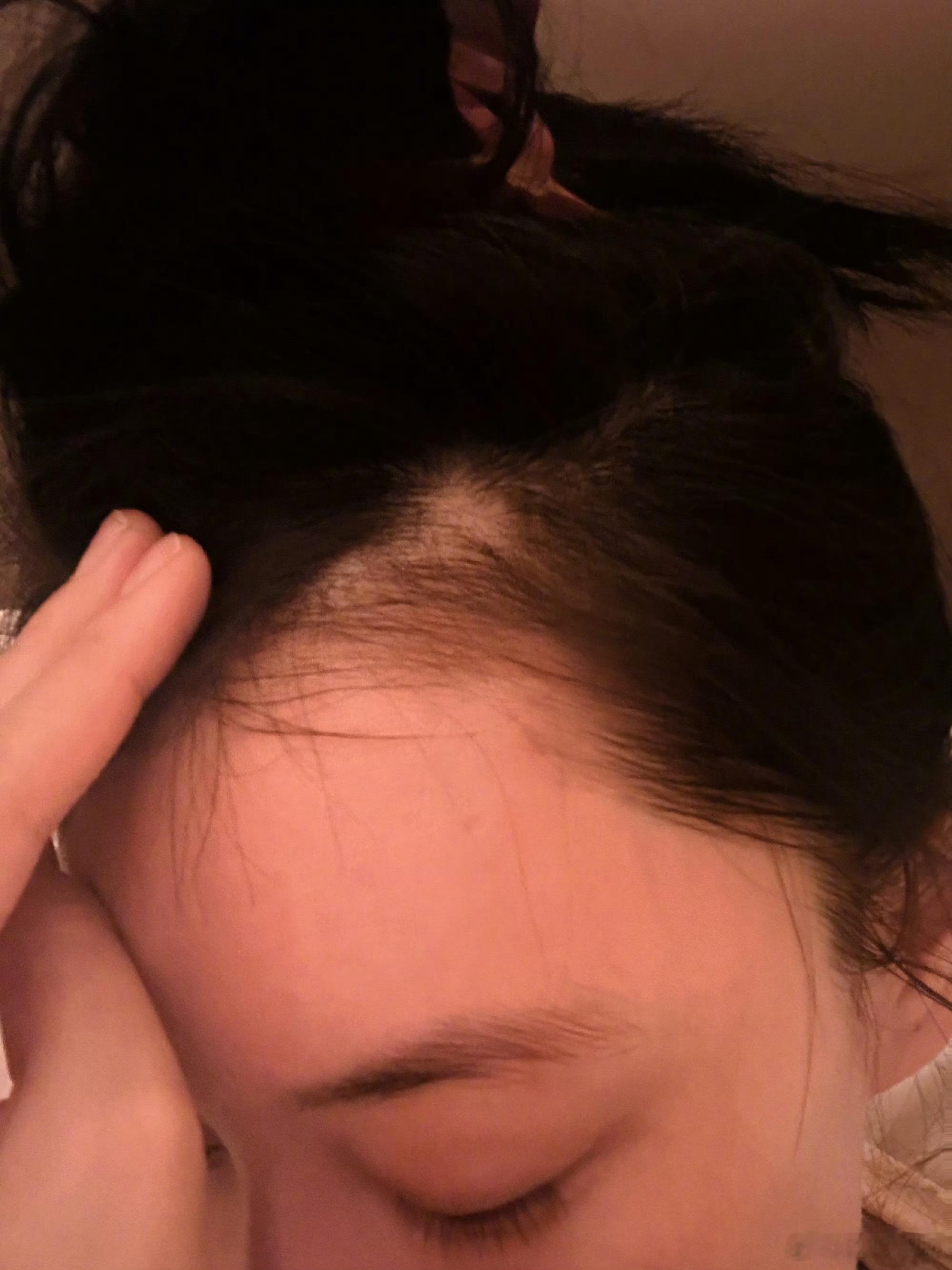 张馨予是真不拿我们当外人啊！在高海拔工作的精神和身体压力大，出现了斑秃！今天又学
