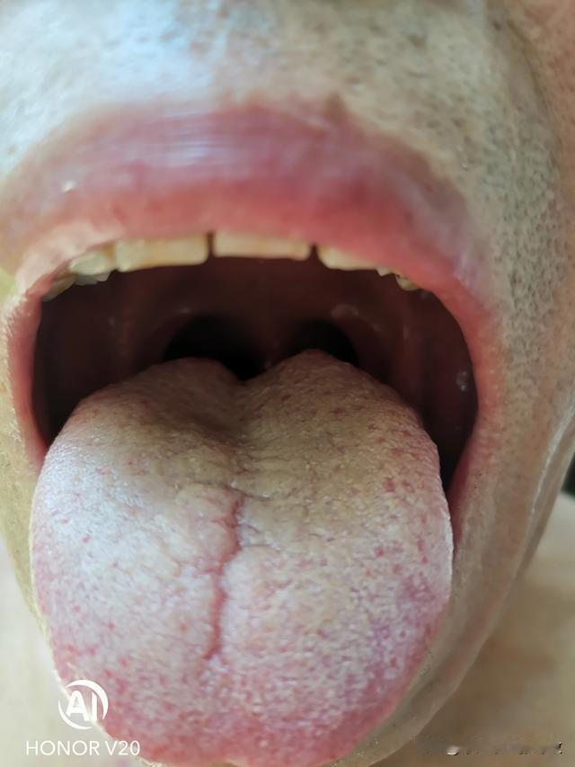 舌中舌根裂纹，看着是脾肾亏虚，但是根本原因却是在肝[狗头][狗头][狗头]

主