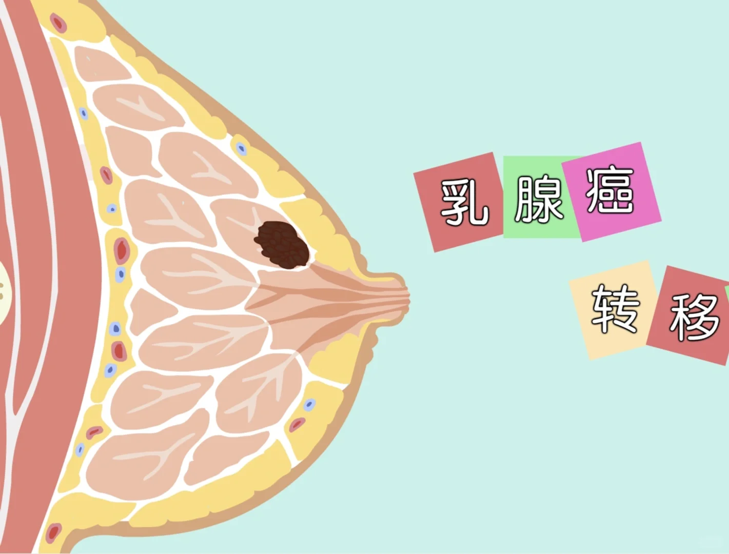 乳腺癌术后第几年最危险‼️重点监测早发现