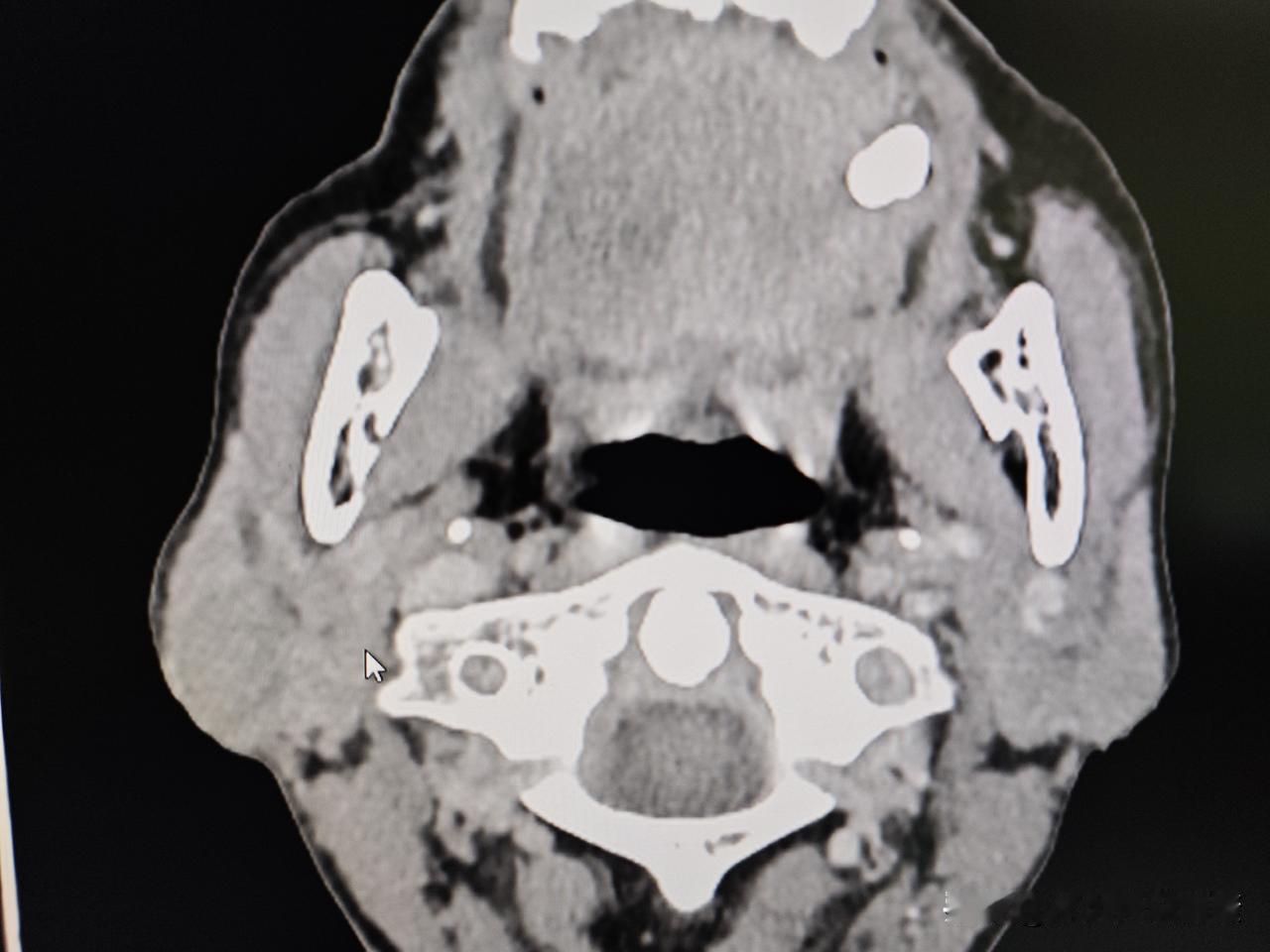 今天完成一例腮腺混合瘤手术切除病例分享，
腮腺混合瘤也算是头颈外科很常见疾病了，