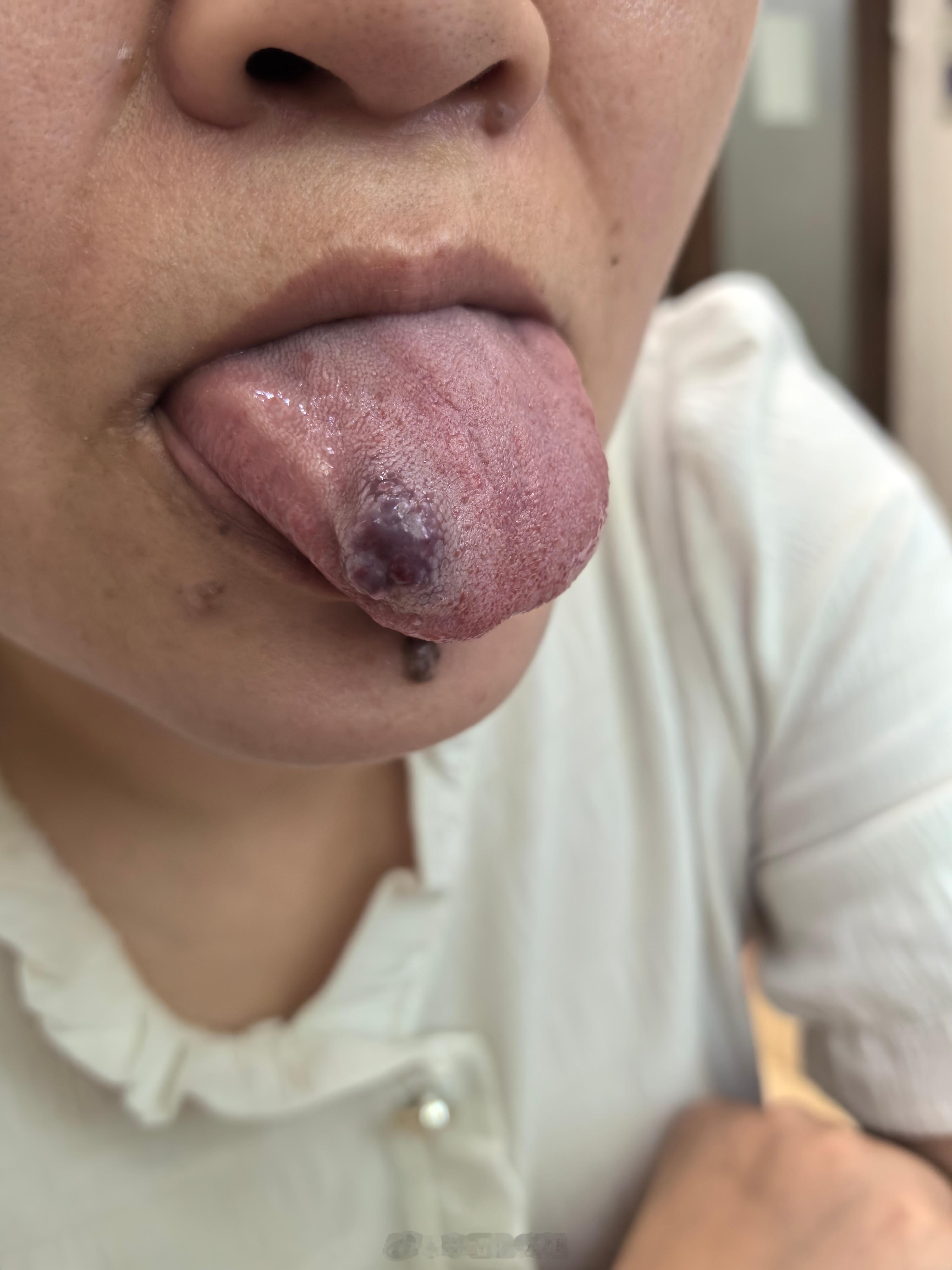 中医  病看多了，什么舌头都碰得到……[揣手][揣手] 