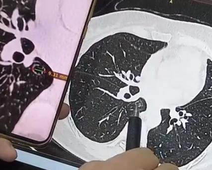 好险！一直以为是良性囊泡，没想到竟是肺癌！前几天接诊了一位患者，真是让人后怕。他
