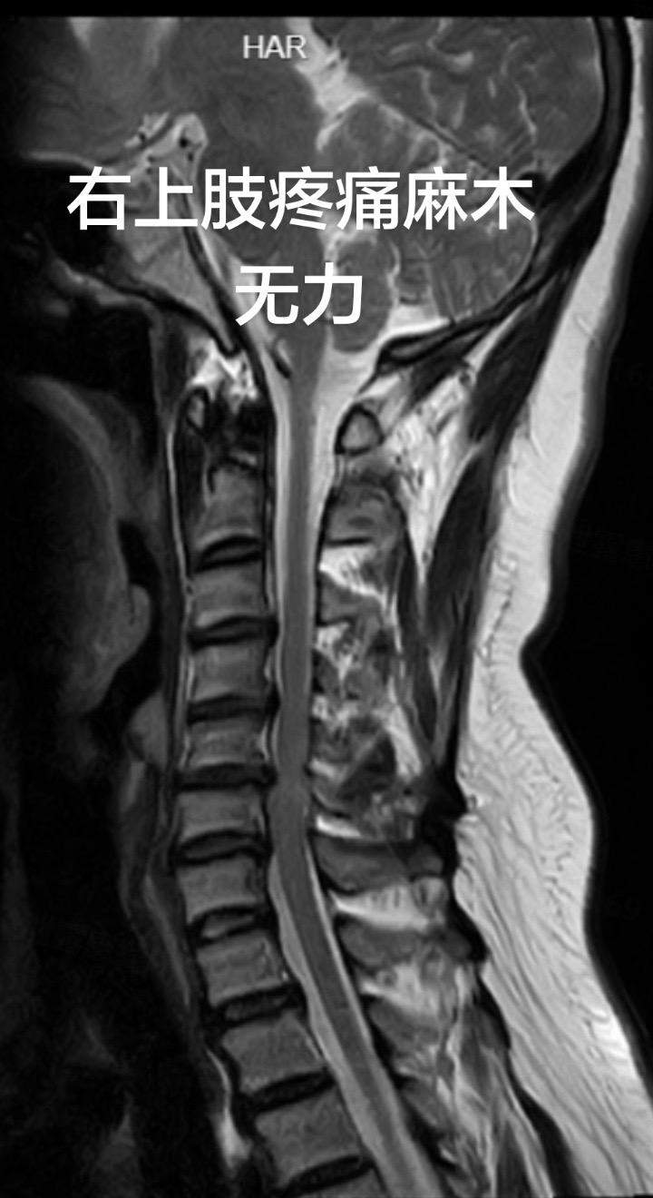 经典的脊髓型颈椎病治疗过程。   发一例很适合做教材的病例，显微镜下颈...