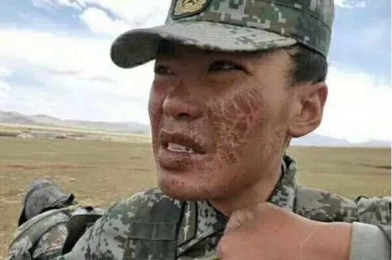 这就是我们的边防军人的脸！他们在海拔很高的地区，天气条件特别恶劣，七八级狂风夹着