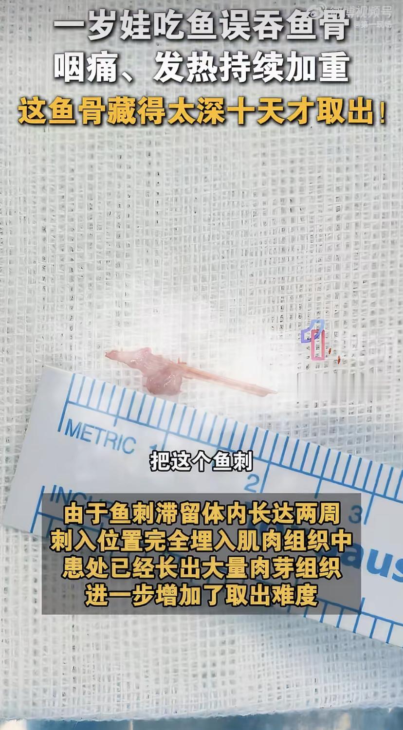 1岁娃吃鱼卡刺，跑了七八趟医院都没找到!
深圳一个1岁宝宝，吃带鱼被刺扎进了喉咙