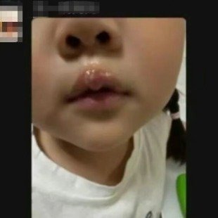 女童被幼儿园老师用热熔胶烫嘴虐待老师是孩子在幼儿园里最信任的人，可她却用最残忍的