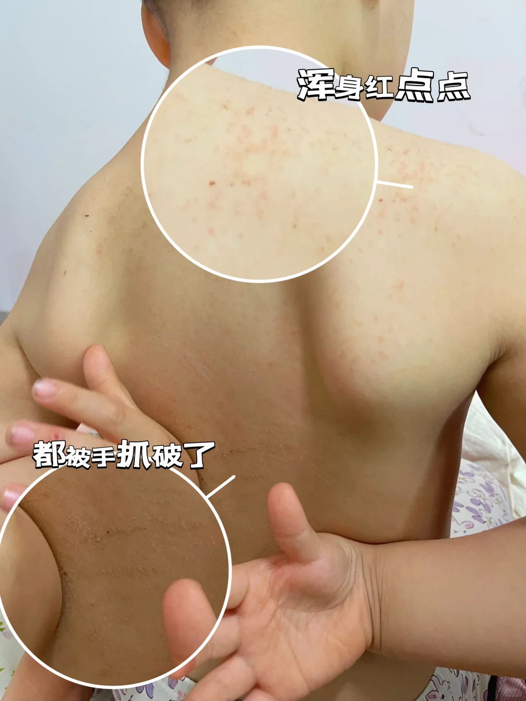 养猫半年！才发现孩子猫毛过敏😭😭😭😭