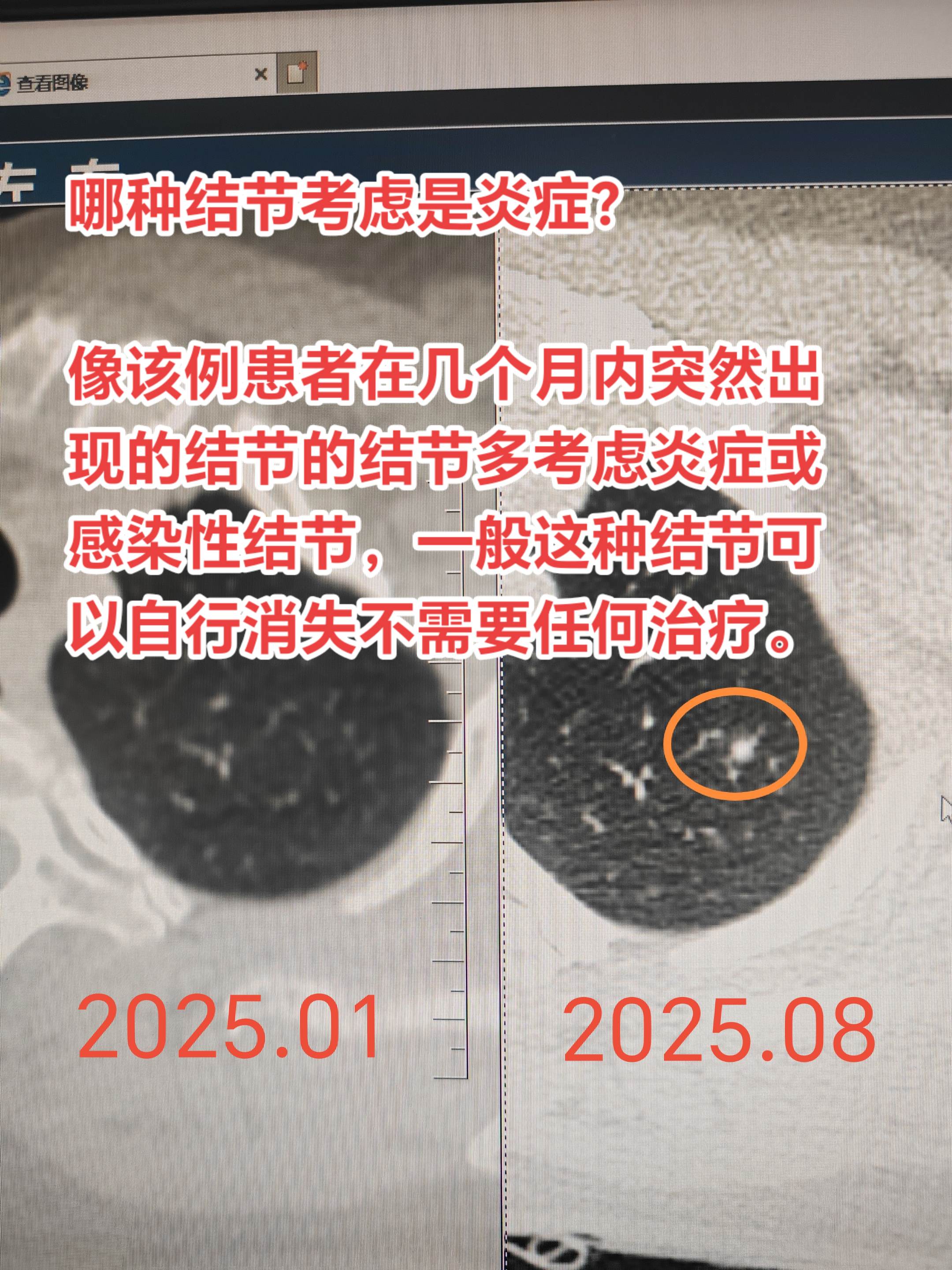 哪种结节考虑是炎症？像该例患者在几个月内突然出现的结节的结节多考虑炎症...