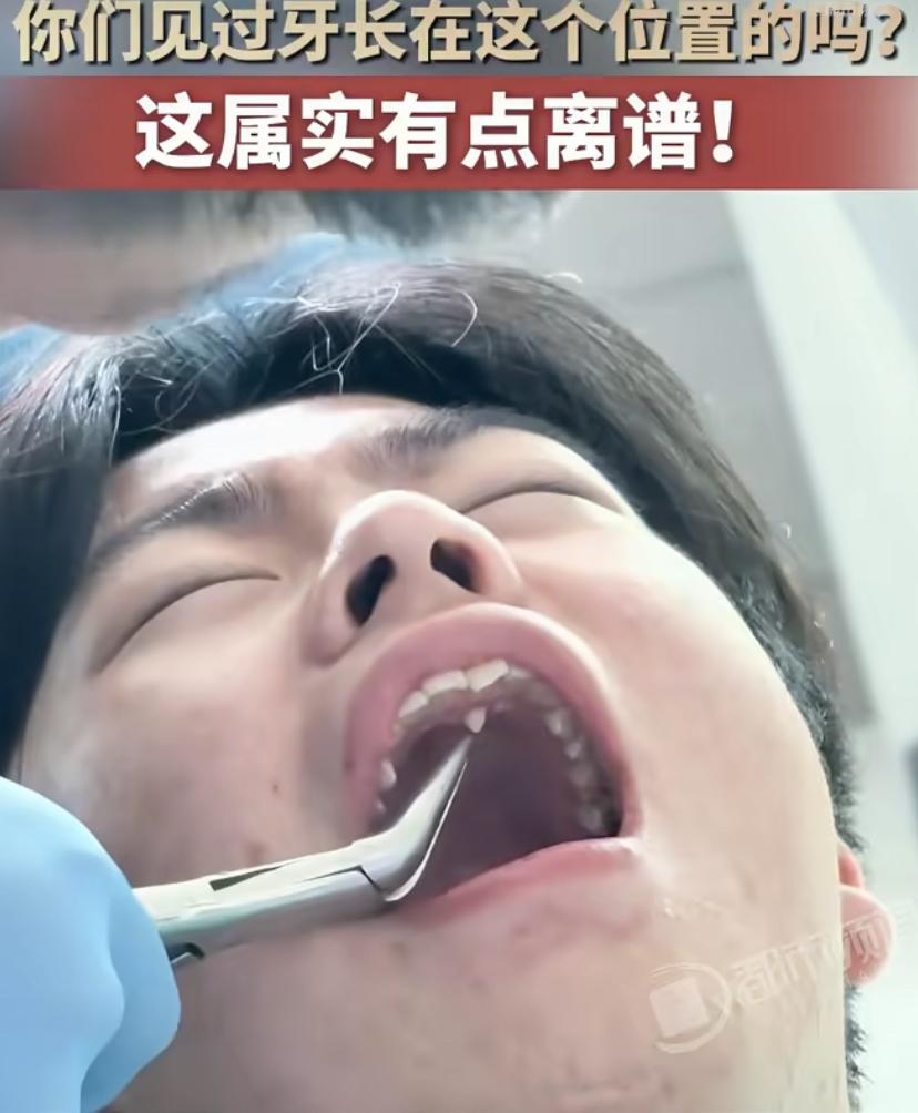 这事儿这两天可太火了!河北一小伙本来高高兴兴去拔牙，结果医生一瞅他嘴，直接愣住了