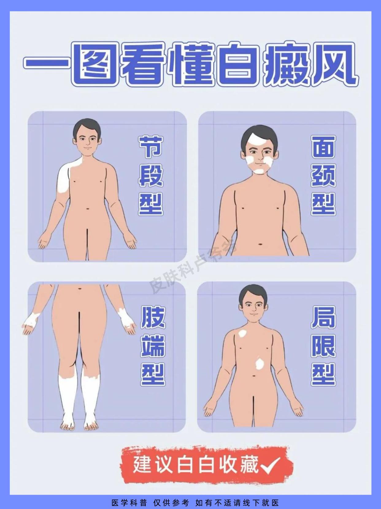 一图教你看懂白癜风的类型