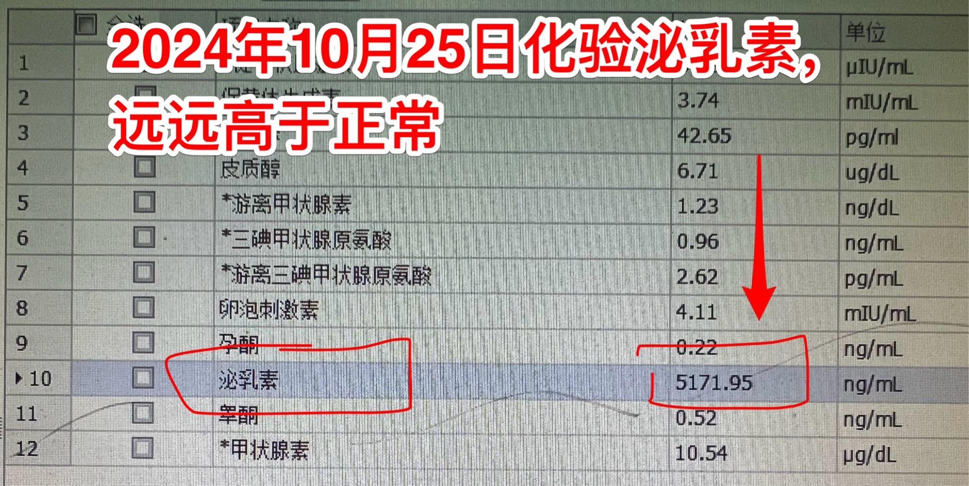 吃药能让垂体瘤消失？这不是传说。垂体瘤中有一种特殊的瘤叫泌乳素瘤，可以...
