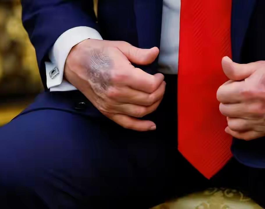 美国政坛即将巨变吗？


前段时间，一些媒体抓拍到特朗普的照片，他手上出现了明显