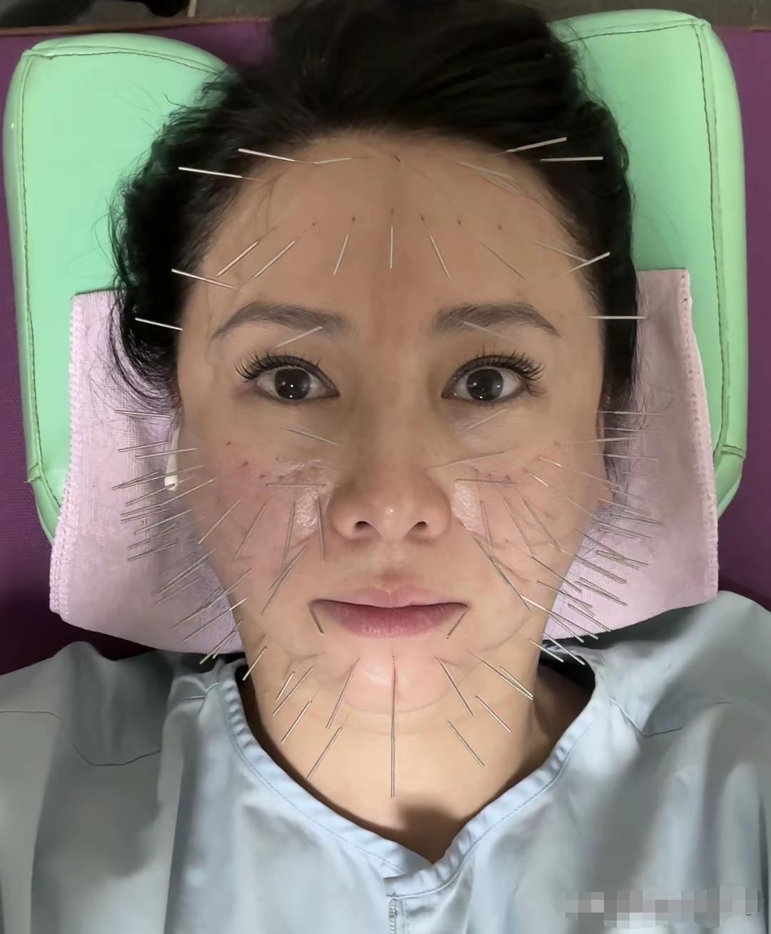 我的老天爷啊，翁虹这是搞的啥玩意啊！插了一脸的细针。这一脸的细针看到都痛哦，简直