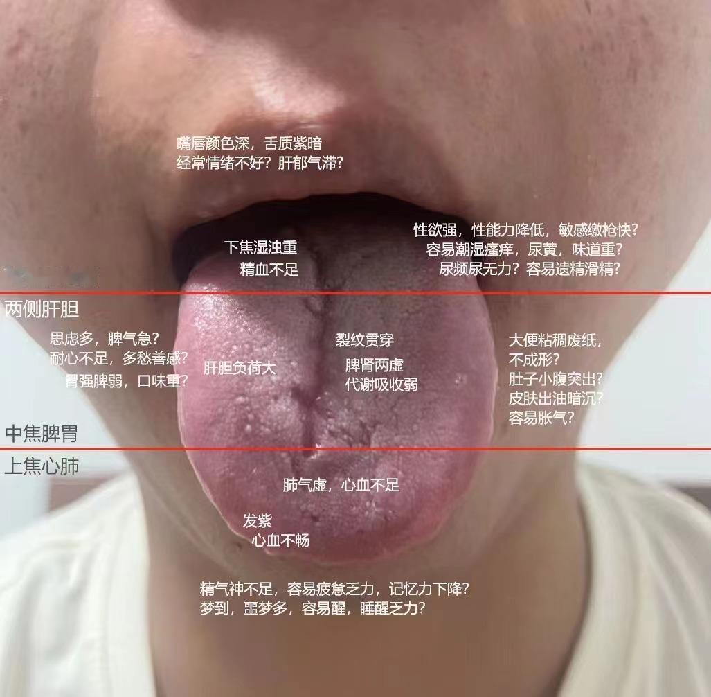 粉丝舌象分析，评论区随机抽取
1、舌根位置——下焦膀胱肾区域
舌头有裂纹，舌色淡