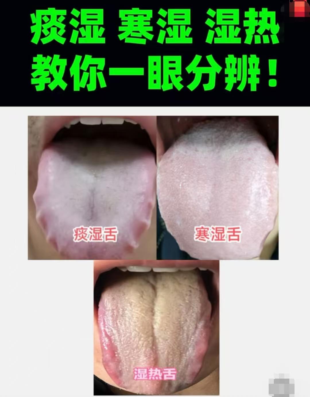 痰湿重浊、寒湿凝滞、湿热黏腻，哪里不同？舌象见分明！
 
1、痰湿重浊----舌