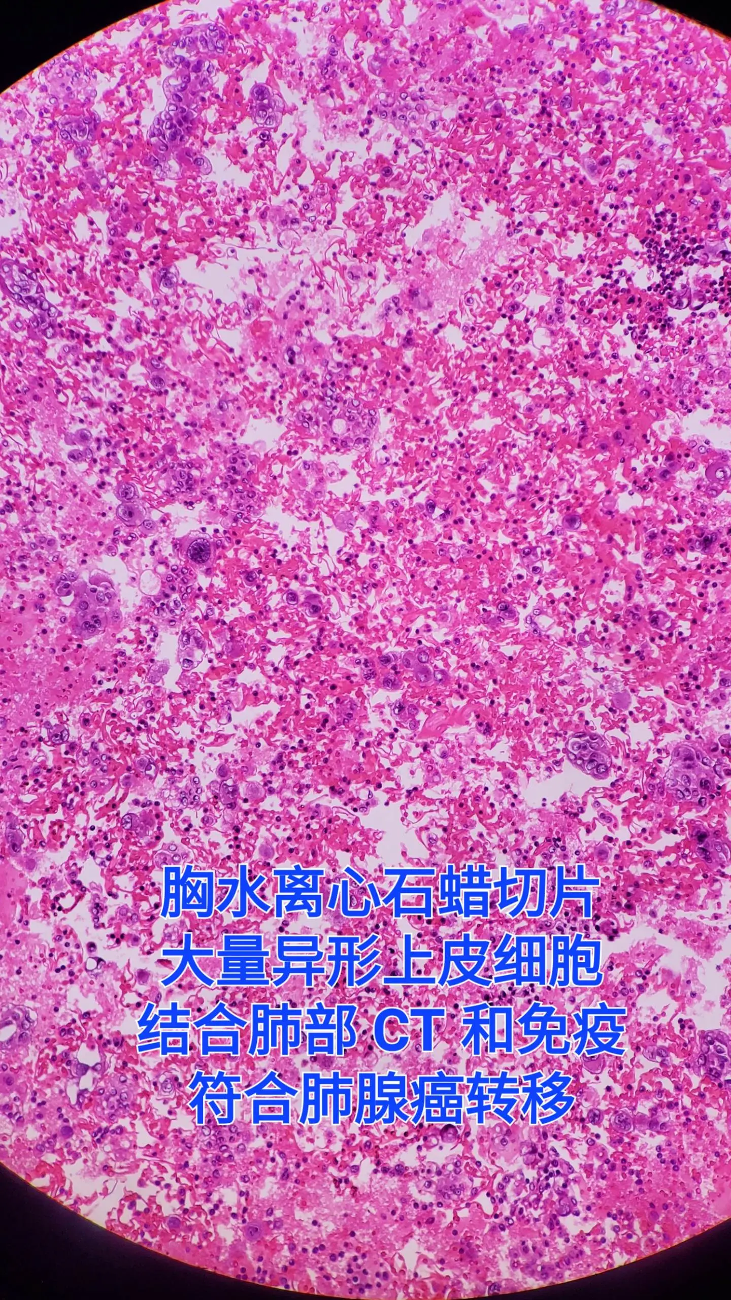 肺腺癌 癌性胸水