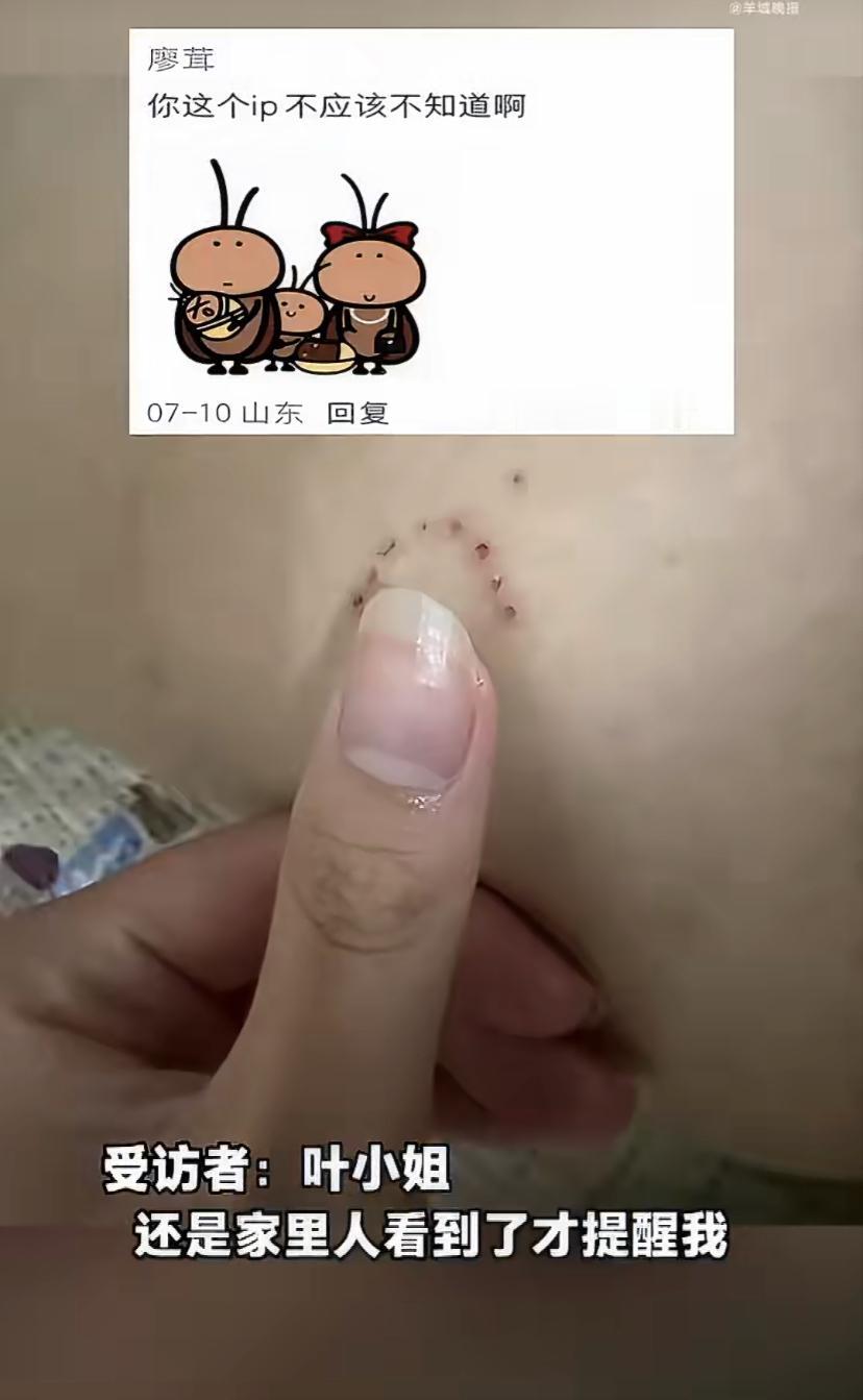 广州的叶小姐最近可被吓坏了!有天她突然发现身上冒出一片片红印子，又痒又慌。她第一