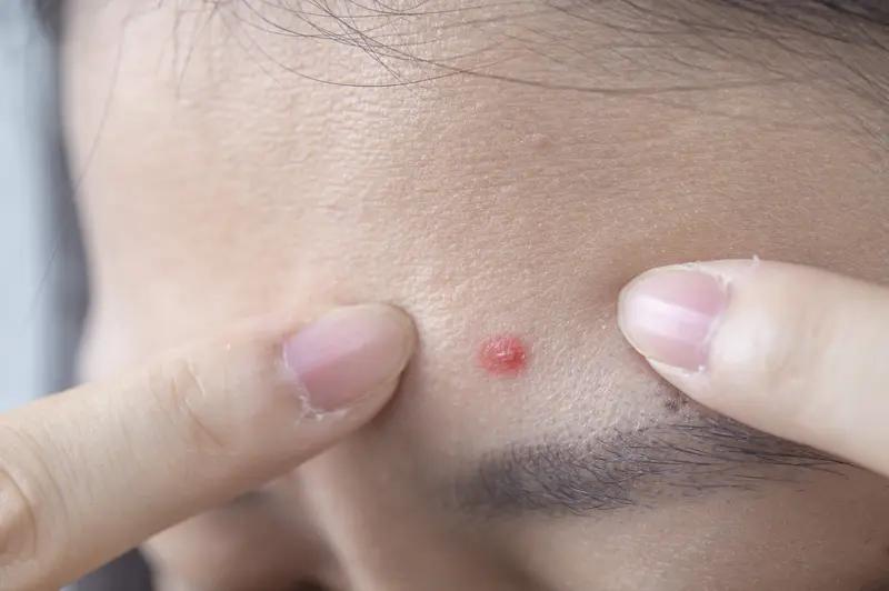 20岁男生挤颗痘痘，肺竟被“啃”出10多个空洞，这事儿真给大家敲响了警钟。大二学