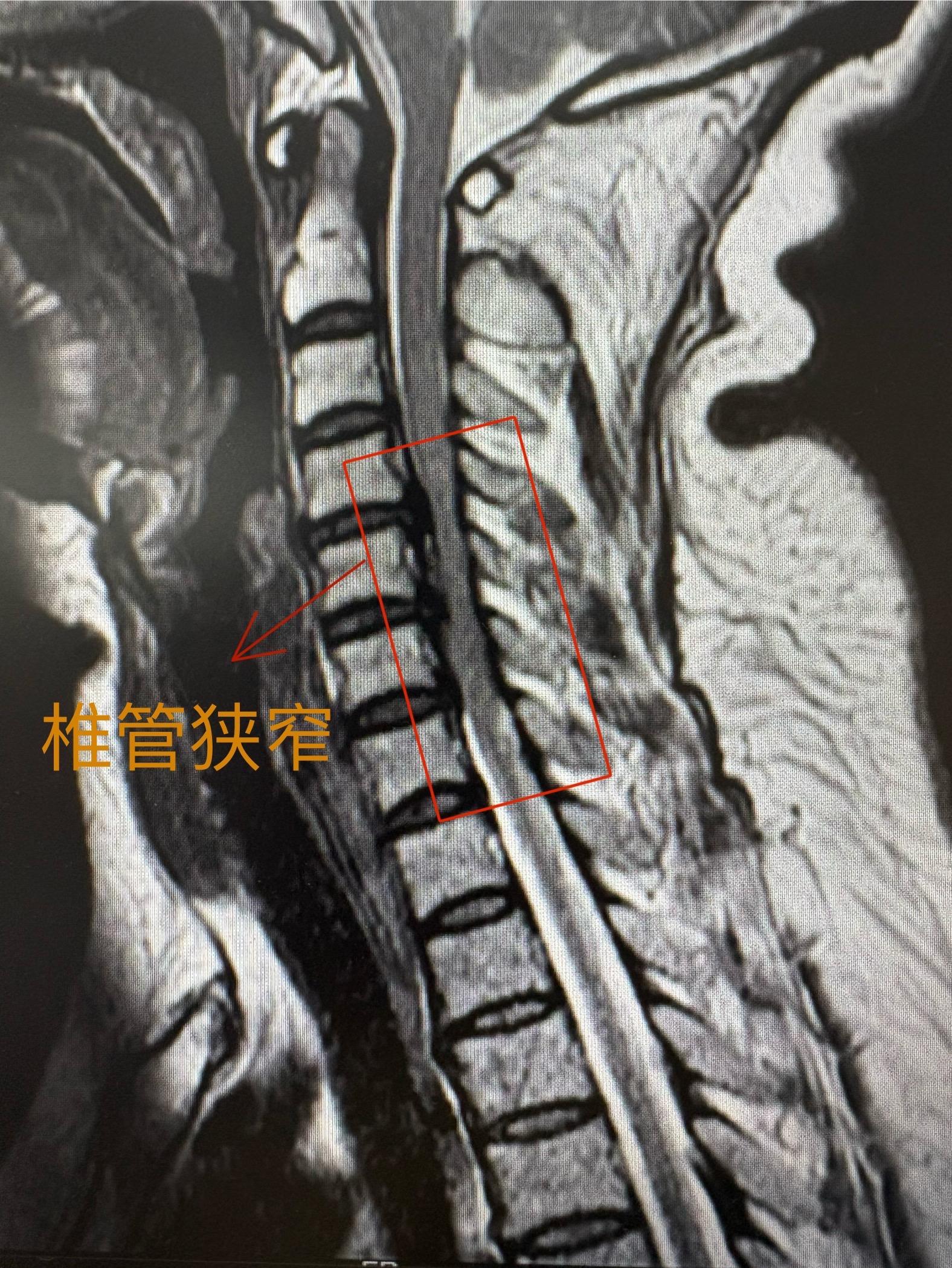 颈椎椎管狭窄 多节段椎管狭窄，上肢的疼痛麻木无力。很适合手术椎管狭窄 ...