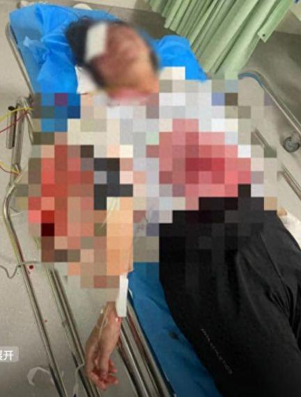 别再叫它“情感纠纷”？福建27岁女子分手两年后，被前男友炸至左手截肢、右眼失明。