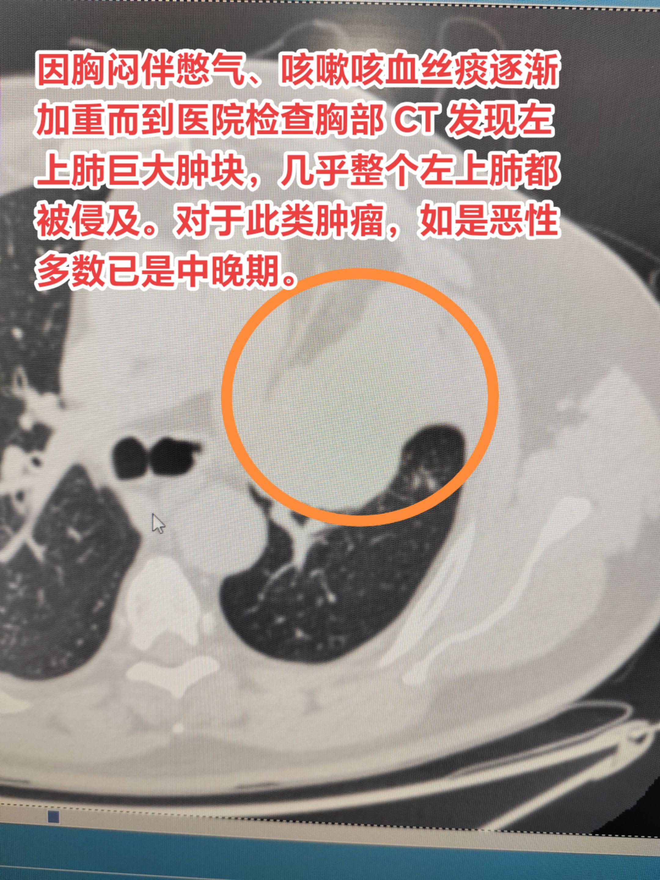 肺癌常见转移部位有哪些？因胸闷伴憋气、咳嗽咳血丝痰逐渐加重而到医院检查...