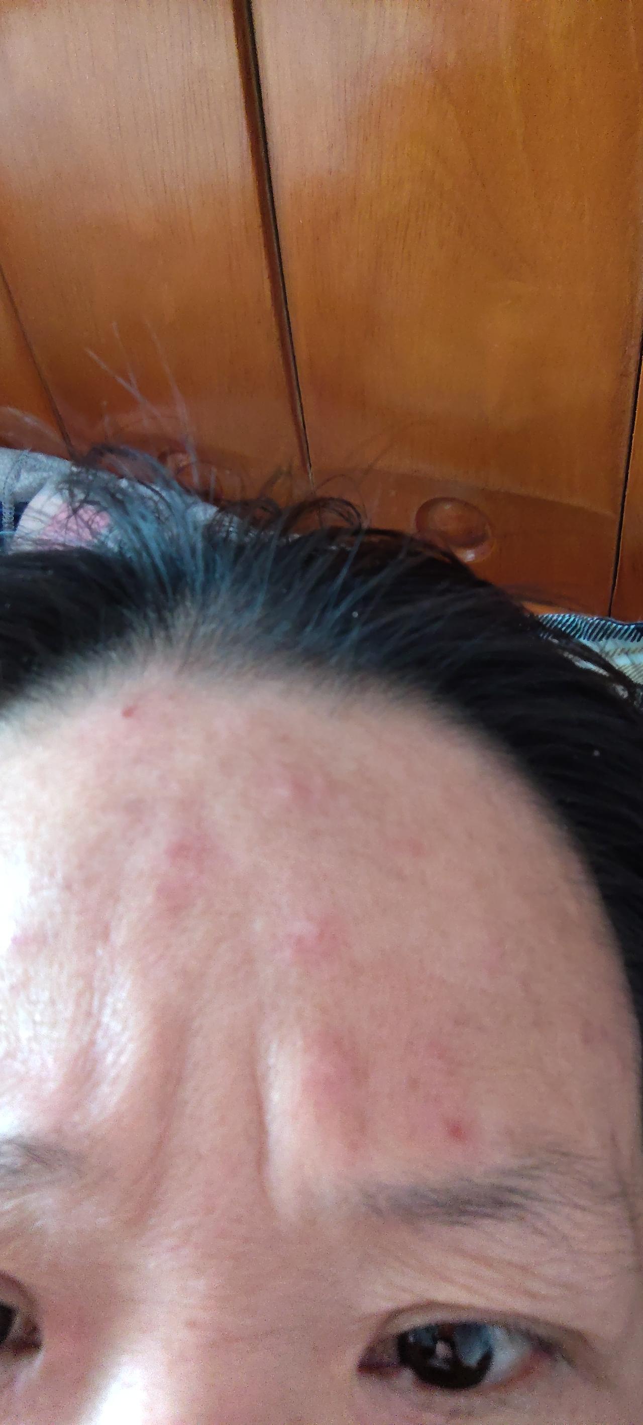 73年的老女人，额头上长满痘痘。我怀疑是吃了醪糟引起的，有这可能吗？