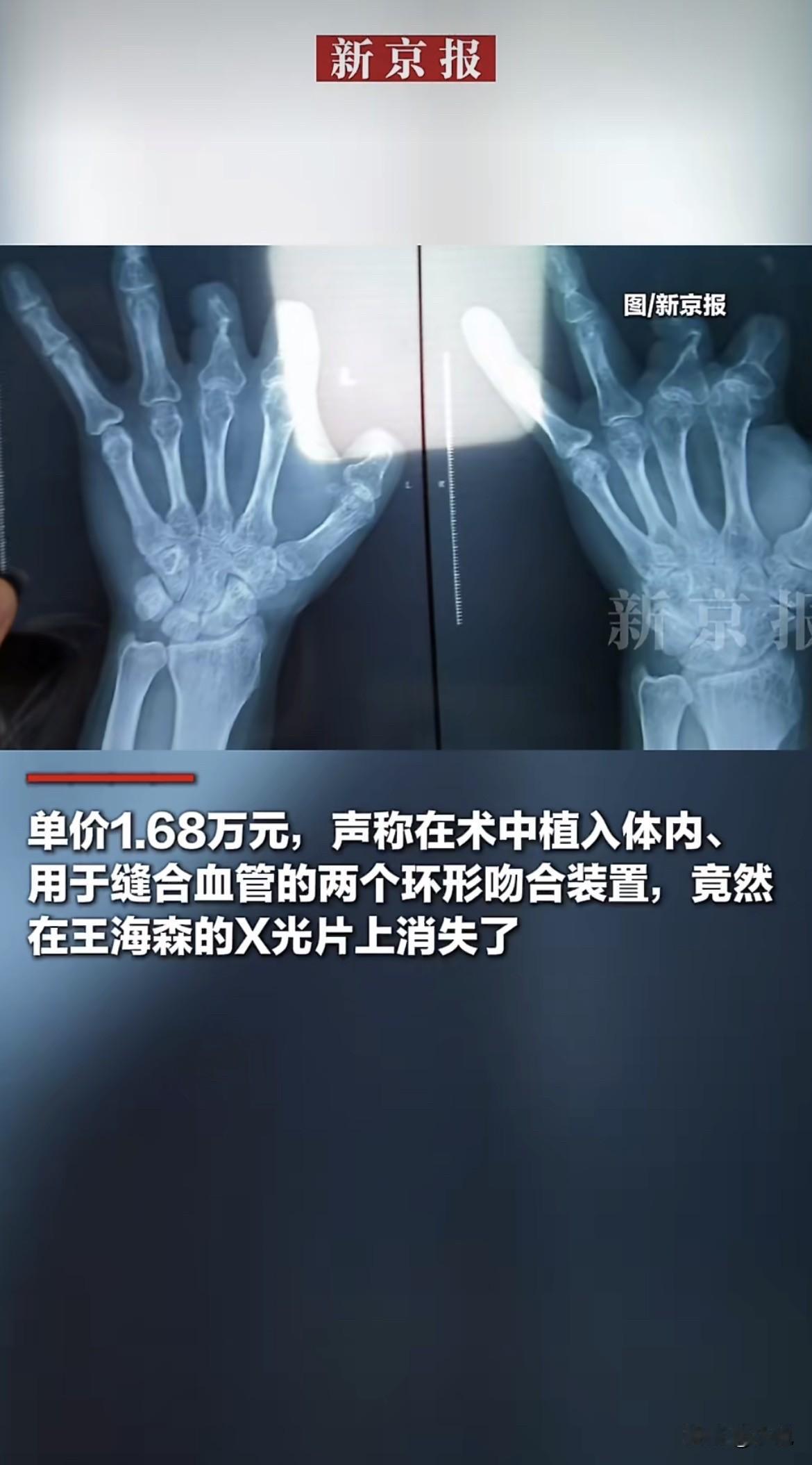 丧心病狂！有医生把患者花钱买的、声称要放进身体的昂贵器材，直接丢进了手术室的垃圾