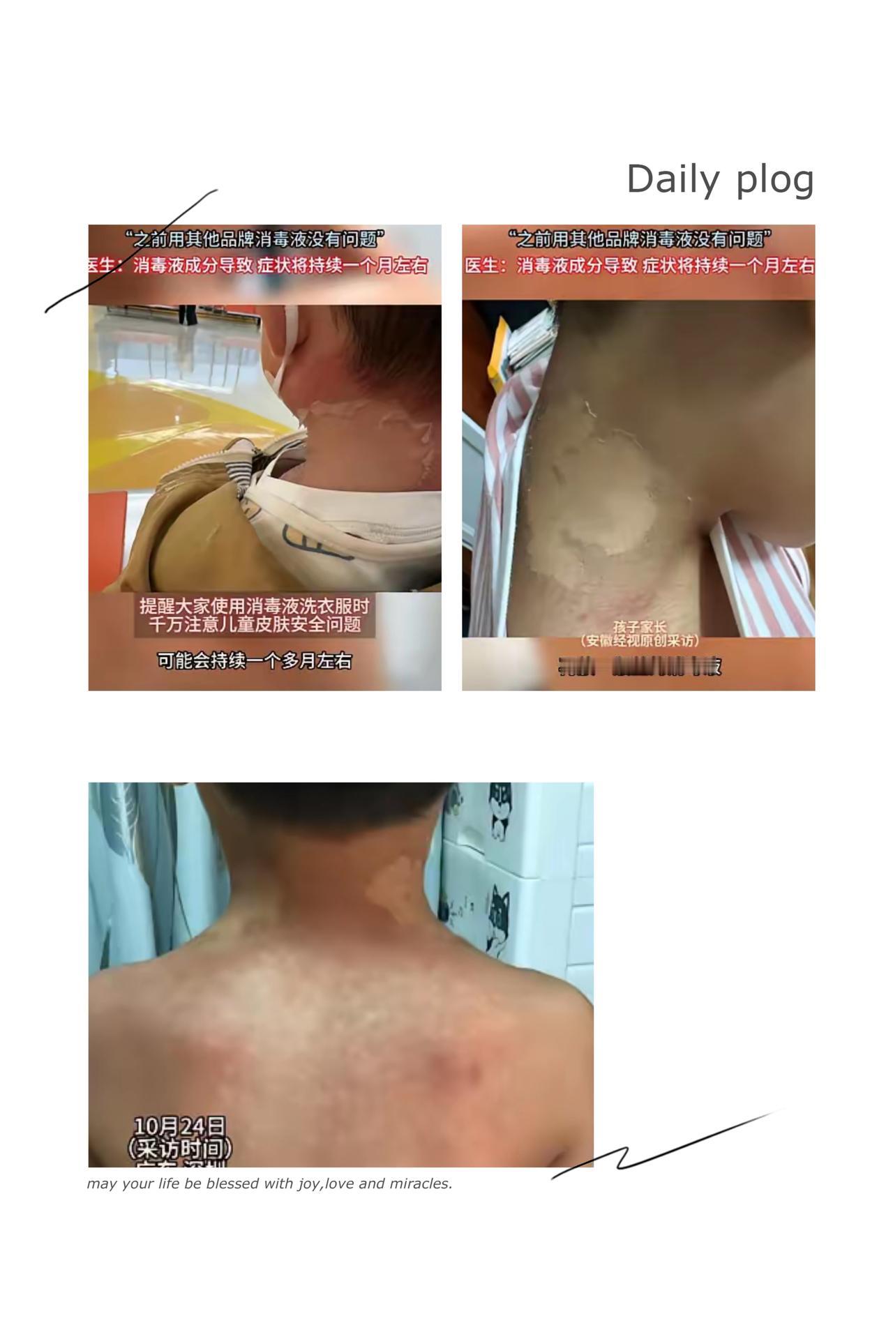 悲剧还是发生了！深圳家长给娃洗衣服加了瓶消毒液，结果6岁娃皮肤被严重腐蚀，又痒又