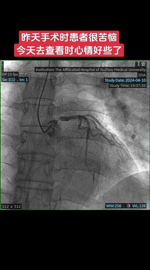 说各项指标控制好了为什么还狭窄呢！？患者很苦恼，明显接受不了！患者17年LAD植入支架，20年外院于RCA药物球囊处理，近期活动后嗓子有辣椒面感觉，造影后显示LM开口重度狭窄，患者家属反复商量半小时后于LM植入一枚支架！作为医生听了这话也无奈呀！