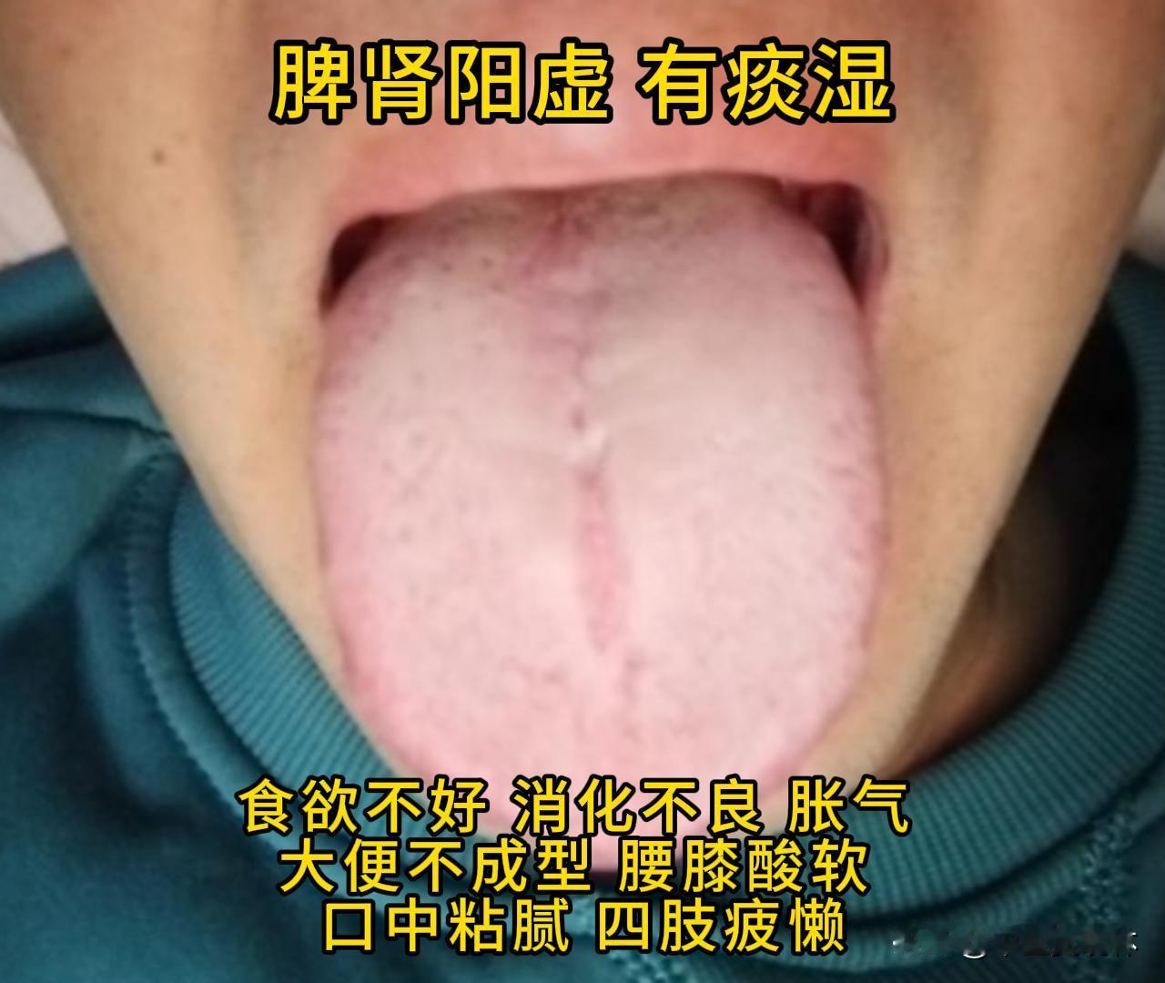 今天有时间，可以帮大家看看舌象。

有需要的，尽管把你的舌象照片发过来吧！越早发