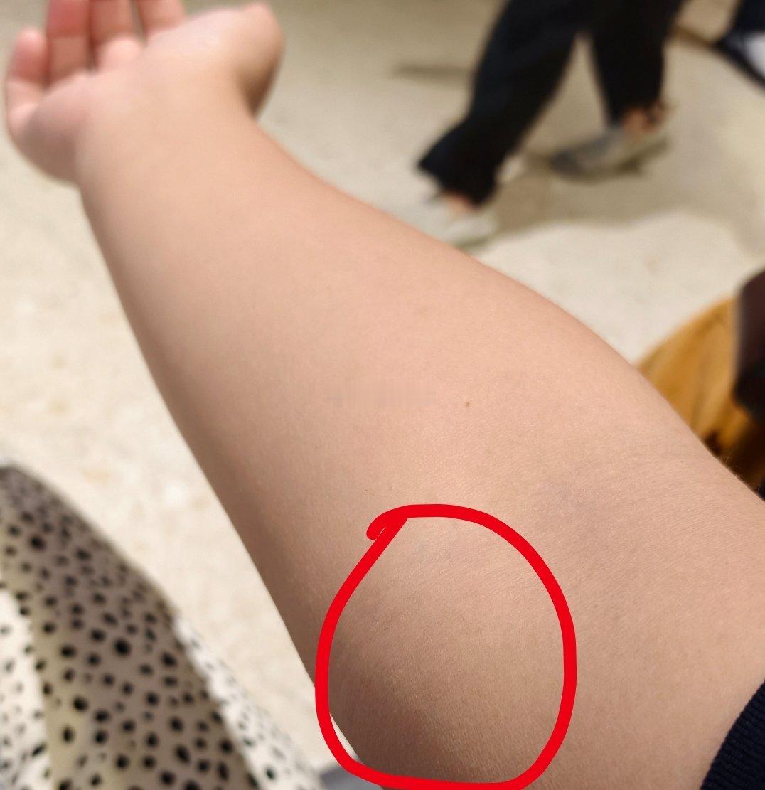 右手臂手窝这里有点疼，过了两天画圈这里有点鼓起来，捏了捏皮下是小颗粒，左手臂也是